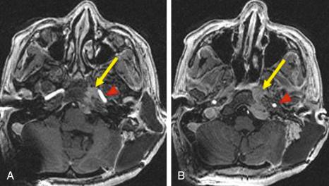 Fig. 30.7, Axial MRI of a left petroclival and petro-occipital chondrosarcoma (yellow arrows) in a patient with persistent headaches in the setting of a nonpneumatized (conchal type) sphenoid sinus. In (A) , more superiorly, there is a tongue of sarcoma abutting, but not compressing, the left pons, but the lesion is kissing the left internal carotid artery (red arrowheads). In (B) , more inferiorly, chondrosarcoma has eroded the clival bone and has crept along the clival dura toward the hypoglossal canal and foramen magnum.