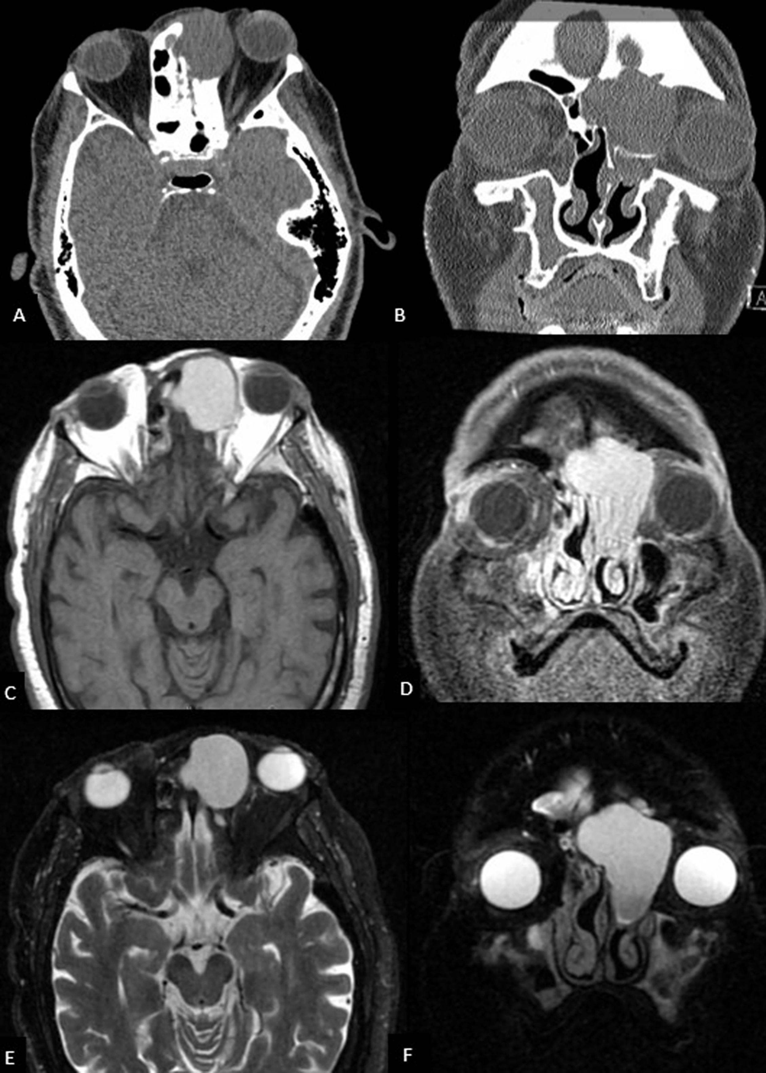 Endoscopic Management of Mucoceles With Significant Orbital Involvement ...