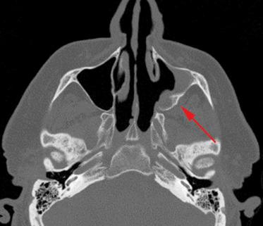 Fig. 21.2, Axial computed tomographic image revealing focal bony hyperostosis (arrow) , which suggests the attachment site of an inverted papilloma.