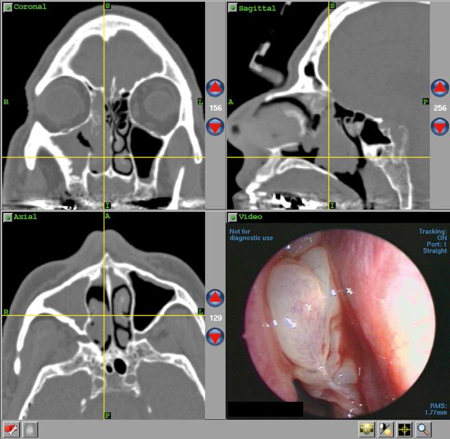 Fig. 21.3, Triplanar images are essential for completing an endoscopic medial maxillectomy. All portions of the maxillary and ethmoid sinuses must be examined for disease.