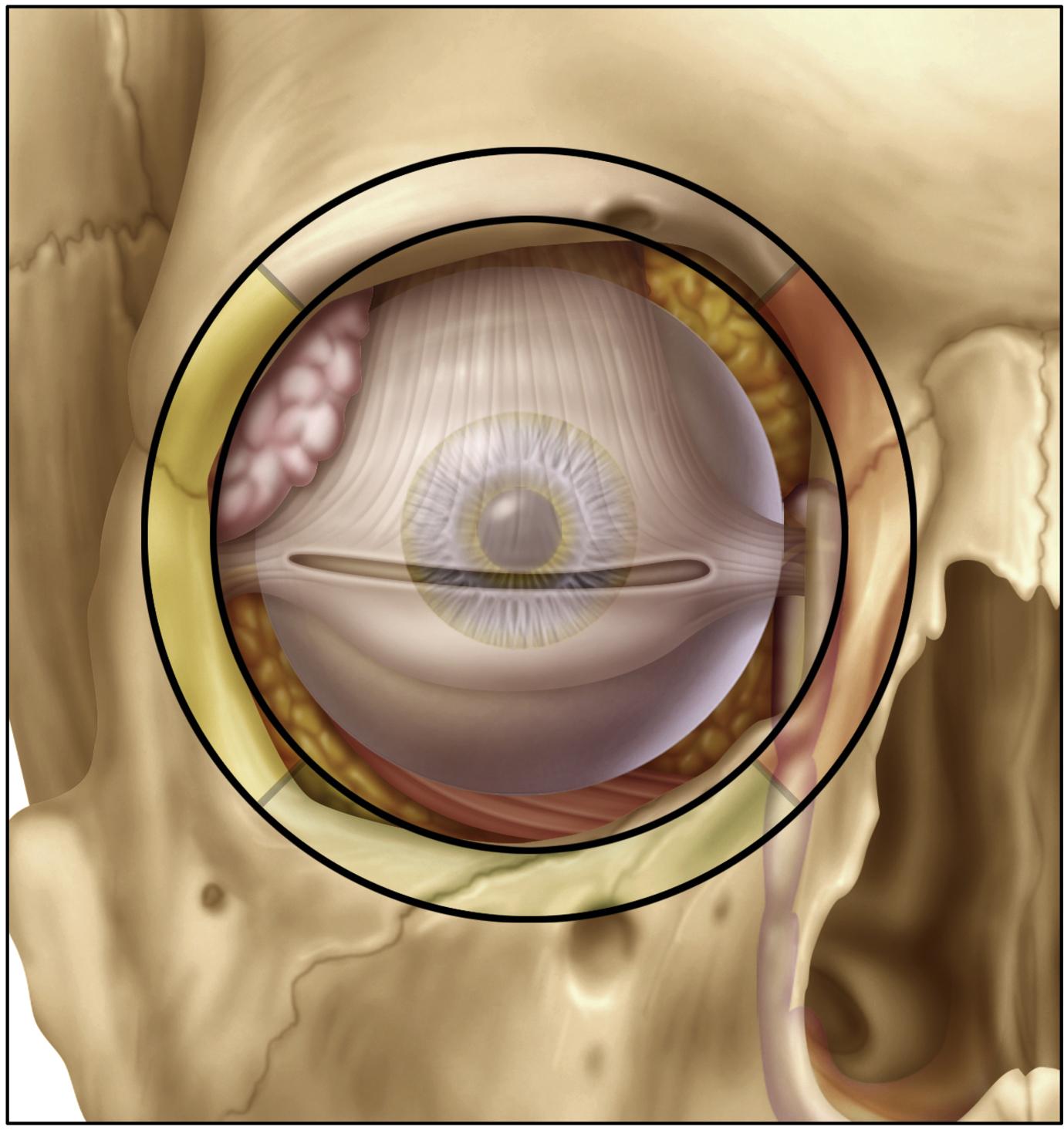 Fig. 3.1, Overview of four quadrants of the orbit. The superior quadrant is the area covered by the superior eyelid crease approach. The lateral quadrant ( yellow ) is covered by the lateral retrocanthal approach with some overlap with the superior eyelid crease. The inferior quadrant is covered by the preseptal lower eyelid approach. The medial quadrant ( red ) is covered by the precaruncular approach.