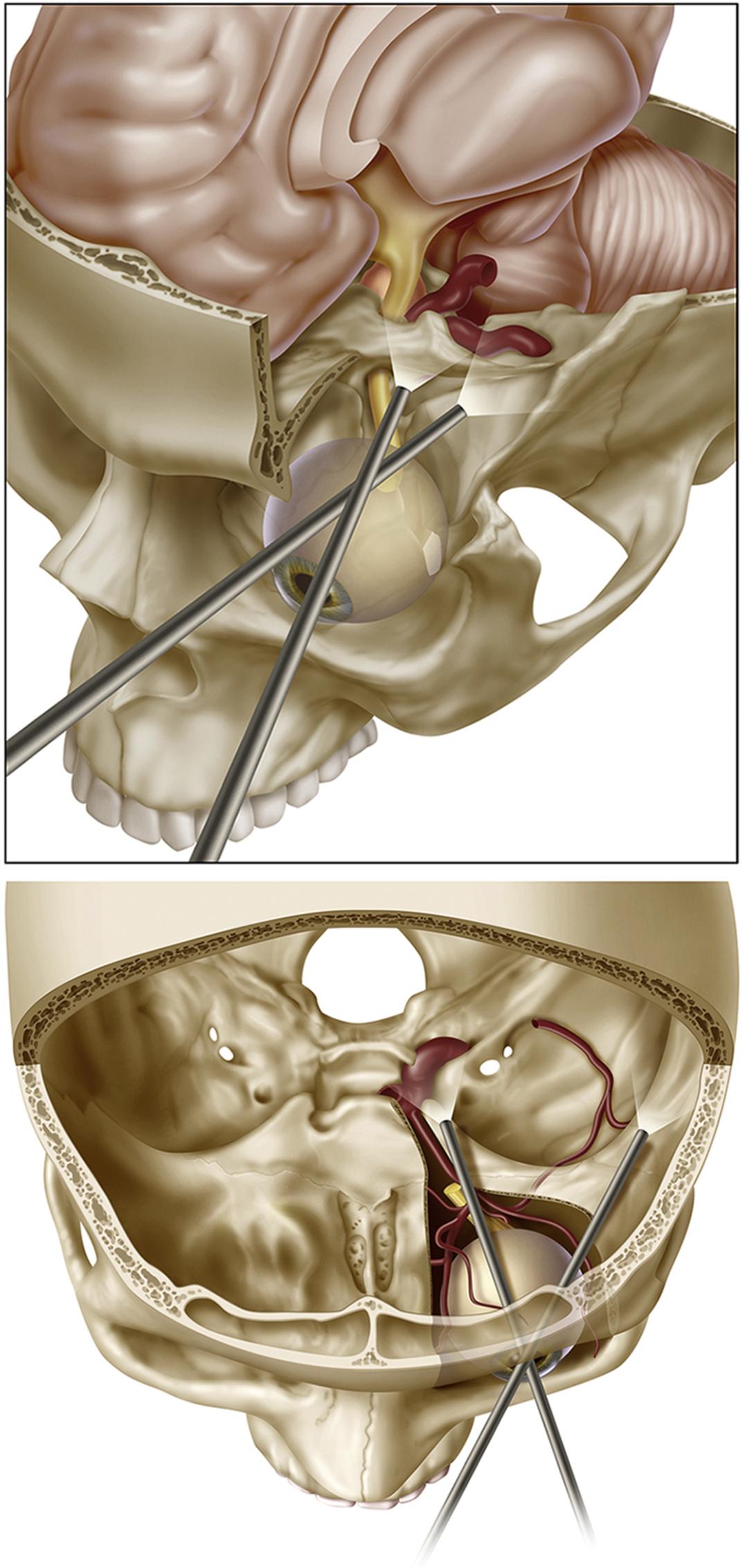 Fig. 3.2, Basic view provided by the superior eyelid approach. The upper panel is a lateral oblique view and the lower panel is an overhead view.