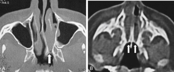 Fig. 5.1, (A) Axial computed tomographic (CT) scan showing unilateral choanal atresia (white arrow). (B) Axial CT scan showing bilateral choanal atresia (white arrows).