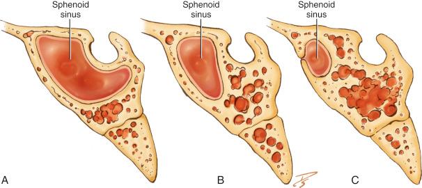 Fig. 28.1, Drawings illustrating configurations of the sella. (A) Postsellar. (B) Sellar. (C) Presellar.