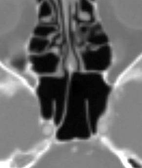Fig. 28.2, Axial computed tomography scan through the sphenoid ostia. Note that the intersinus septum attaches adjacent to the right internal carotid artery. Additional incomplete septa are seen.