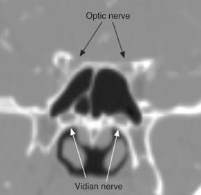 Fig. 28.4, Coronal computed tomography scan of the optic and vidian nerves.