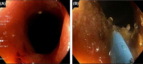 Figure 14.3, A spindle-shaped stricture from Crohn's disease and needle knife therapy. (A) The stricture were not traversible to a pediatric colonoscope; (B) the stricture was treated with needle-knife stricturotomy.