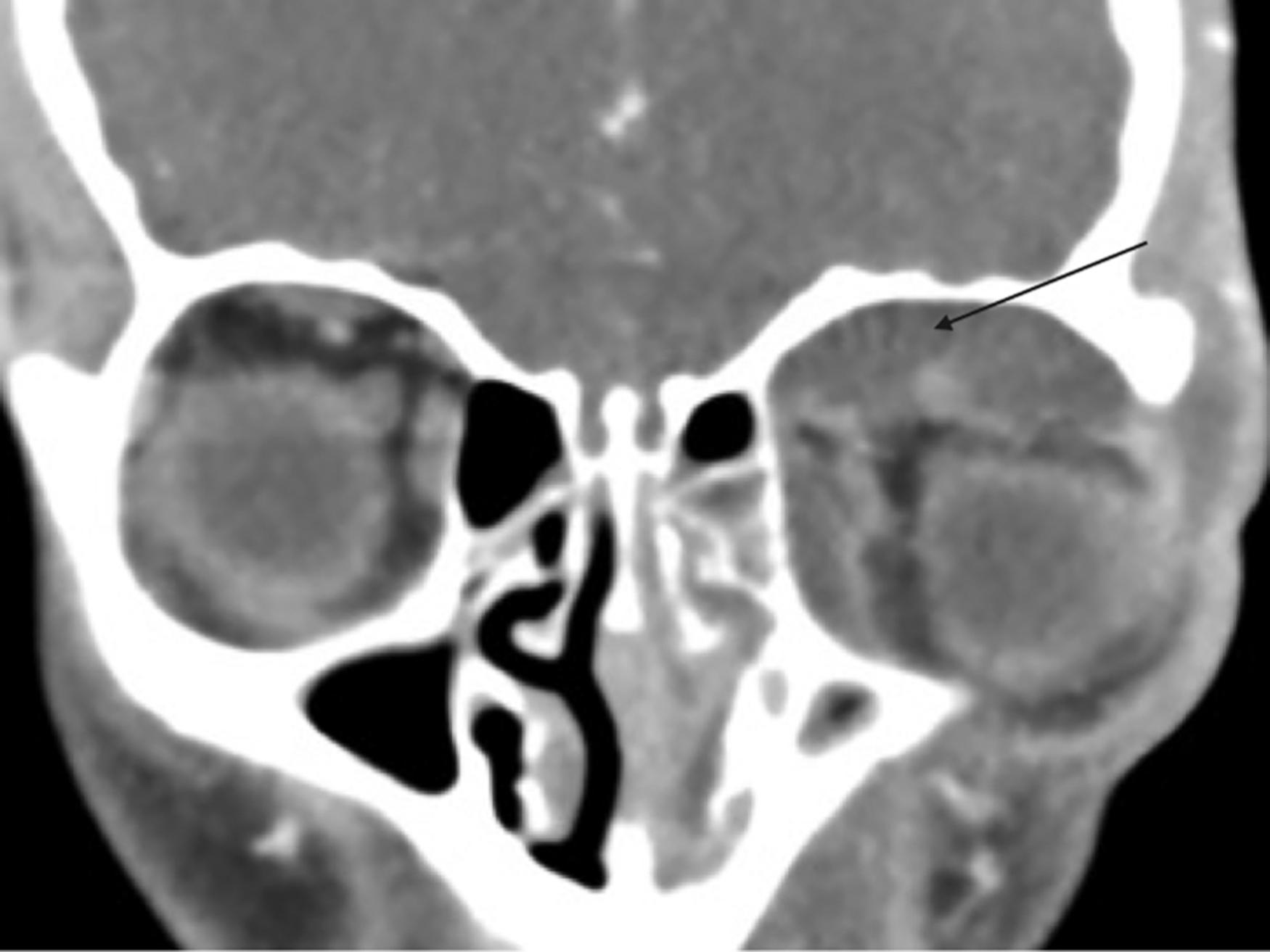 Fig. 30.1, Computed tomography scan of sinus with contrast, coronal cut showing left subperiosteal medial and superior abscesses ( arrow ).