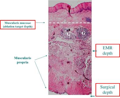 Figure 13.1, Histology of ablation and endoscopic mucosal resection/endoscopic submucosal dissection depths of tissue removal.