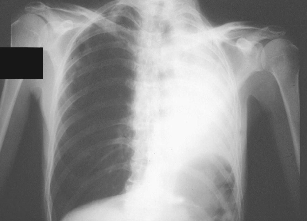 FIGURE 6-2, Radiographic picture of lung cancer obstructing the left mainstem bronchus before photodynamic therapy.