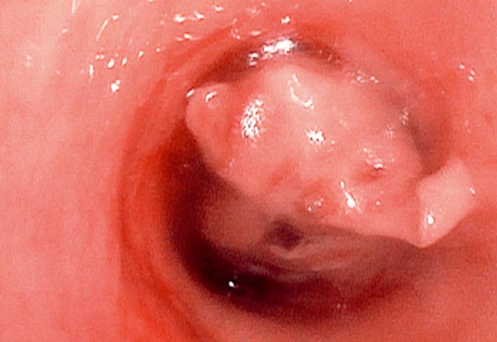 FIGURE 6-3, Bronchoscopic picture before photodynamic therapy.