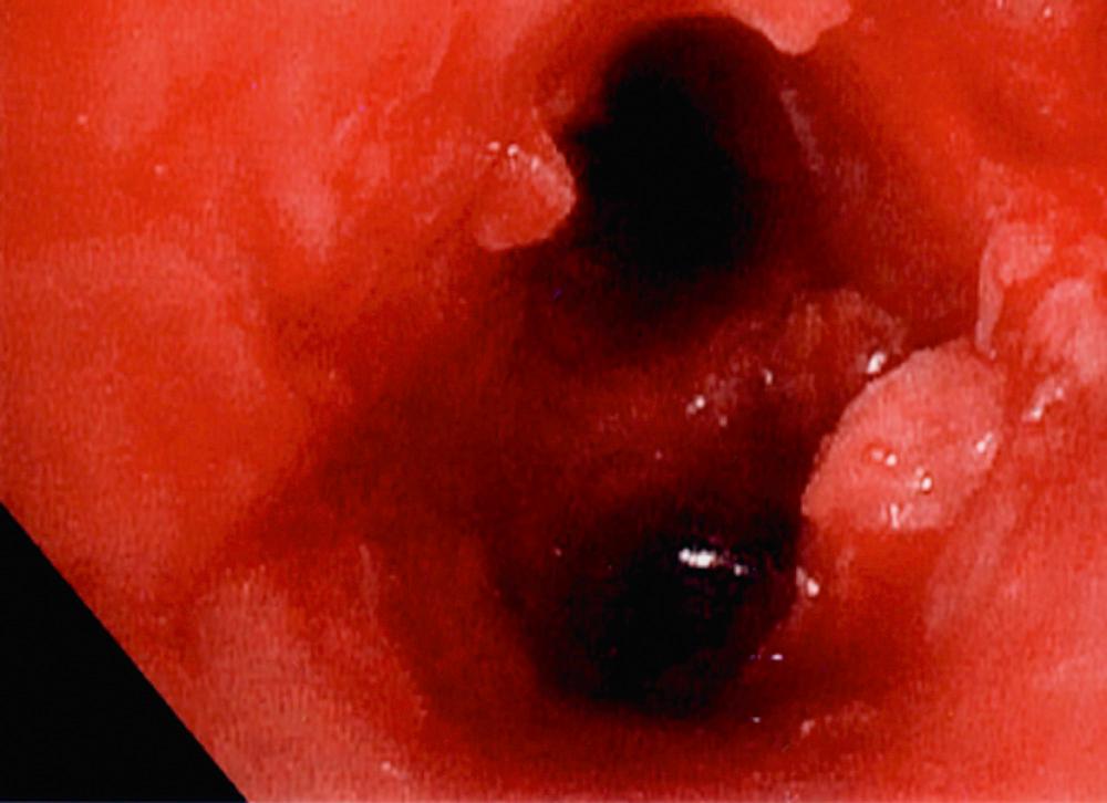 FIGURE 6-5, Bronchoscopic picture after photodynamic therapy.