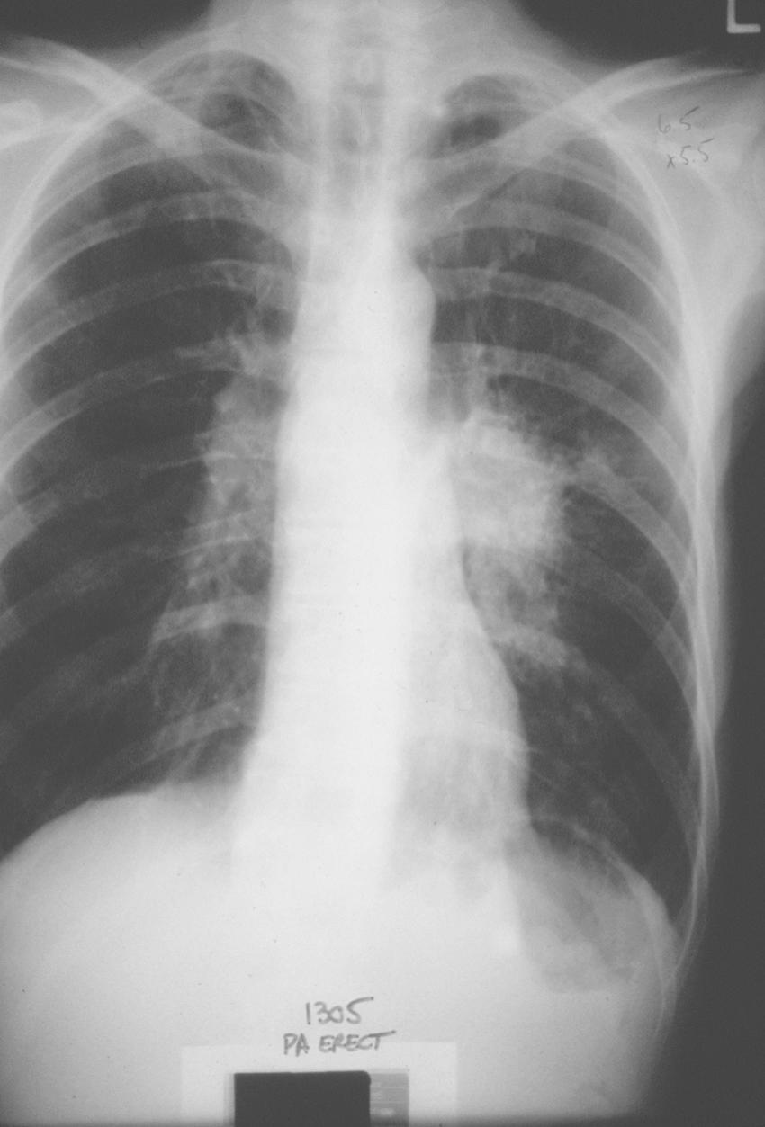 FIGURE 6-6, Radiographic picture after photodynamic therapy.