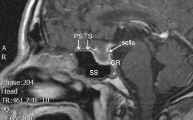 Fig. 29.1, Sagittal T1-weighted magnetic resonance image (MRI) of a pituitary adenoma. The long arrow identifies the sella turcica, containing a pituitary adenoma (sella). Short arrows identify the planum sphenoidale (PS) and tuberculum sella (TS). Note that the tuberculum sella is between the planum sphenoidale and the sella turcica. The clival recess (CR) is posterior and inferior to the sella and is superior to the clivus (asterisk). SS, Sphenoid sinus.