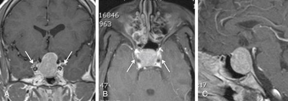 Fig. 29.3, T1-weighted MRIs in coronal (A) , axial (B) , and sagittal (C) planes, which allow a three-dimensional evaluation of the pituitary mass. The arrows identify the cavernous sinuses and the cavernous portion of the carotid arteries.