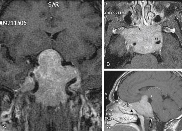 Fig. 29.5, Gadolinium-enhanced T1-weighted MRIs in the coronal (A) , axial (B) , and sagittal (C) planes demonstrating a large pituitary macroadenoma that involves the third ventricle superiorly (single asterisk), the temporal lobe and the bilateral carotid arteries laterally (double asterisks), the sphenoid and posterior ethmoids anteriorly (triangle), and the clivus inferiorly (circle).