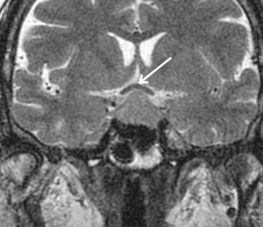 Fig. 29.6, Coronal T2-weighted MRI showing superior displacement of the optic chiasm (arrow) caused by a pituitary macroadenoma.