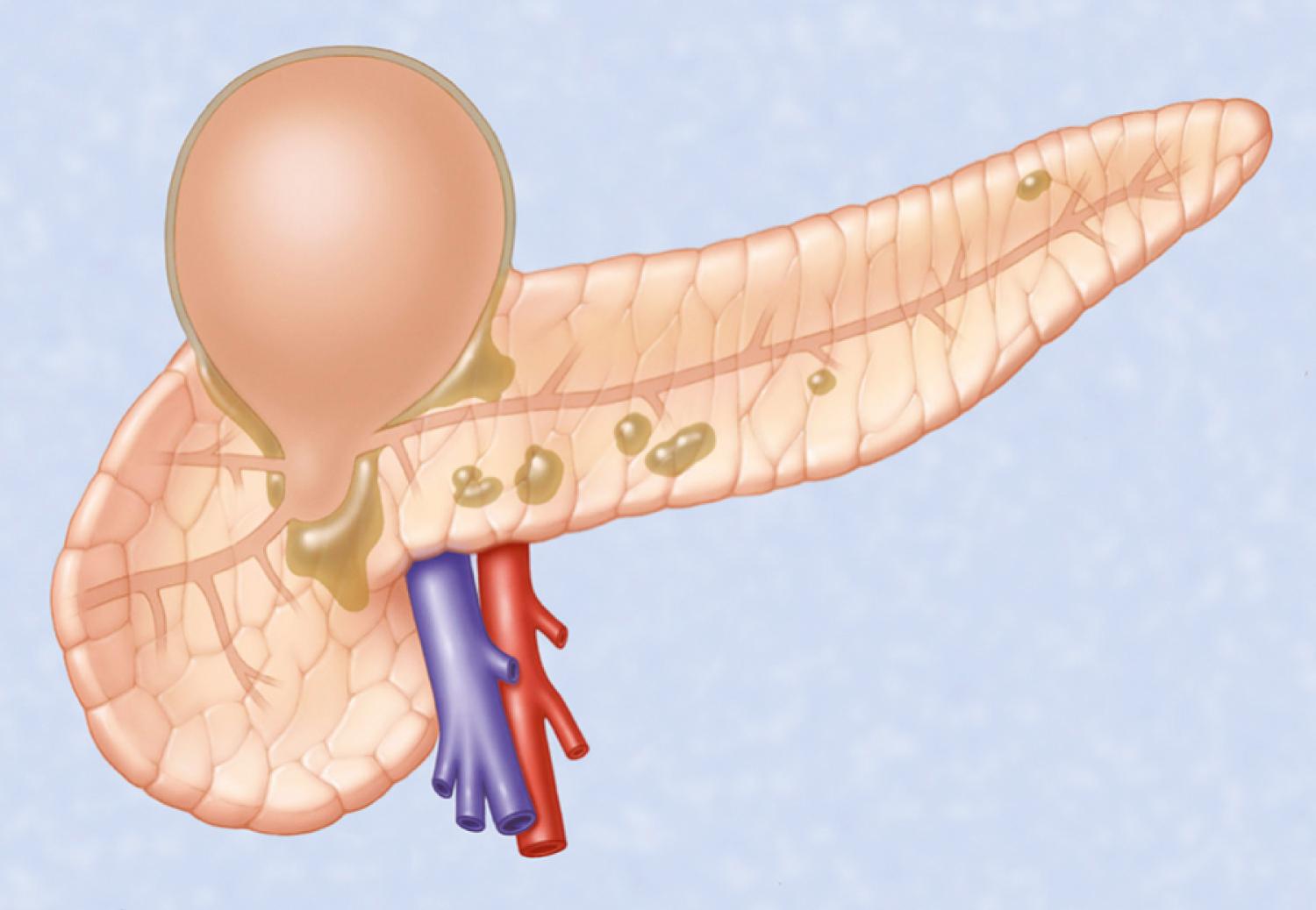 Fig. 61.1, Illustration depicting the mechanism of formation of an acute pancreatic pseudocyst. Limited necrosis of the main pancreatic duct produces a leak with accumulation of enzyme-rich fluid.