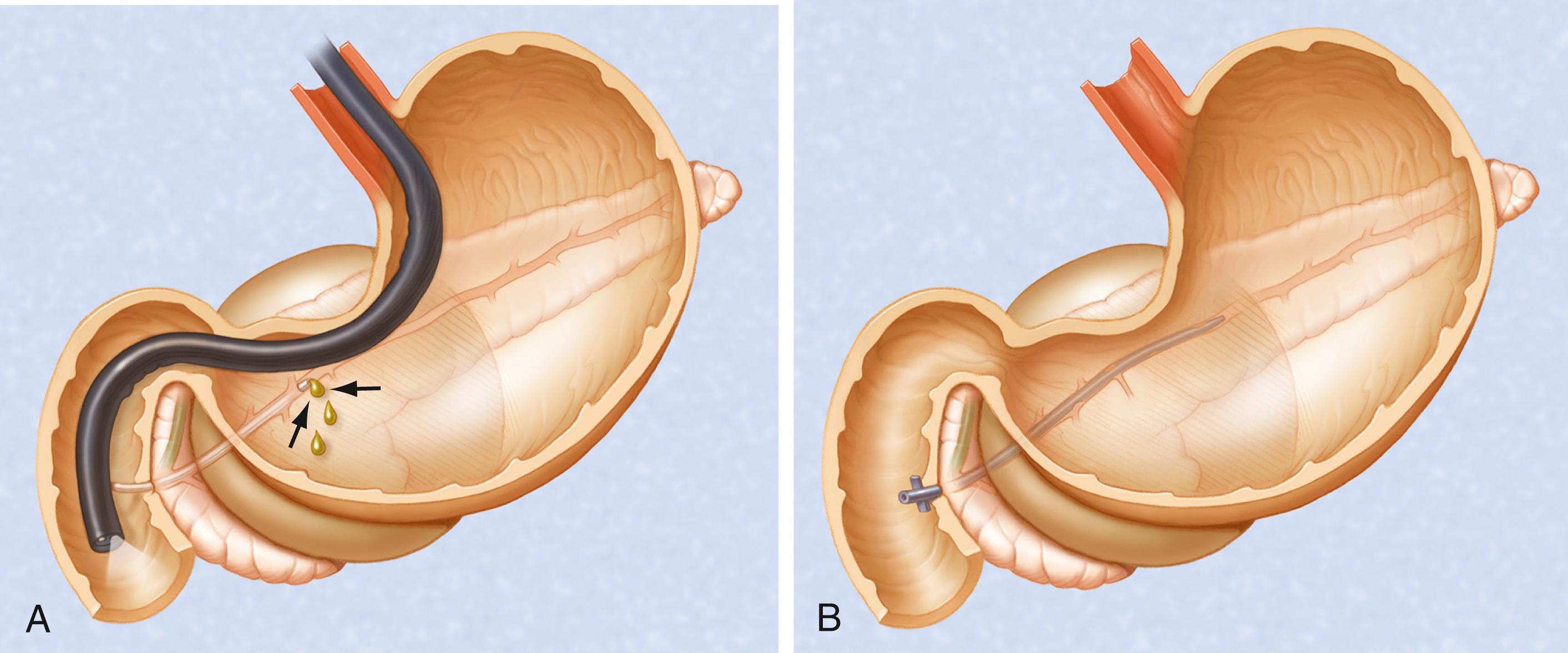 Fig. 61.2, Illustration depicting transpapillary drainage of a pancreatic pseudocyst. A, Pancreatogram showing a leak off a side branch of the main pancreatic duct (arrows) . B, A pancreatic duct stent is in place across the leak.