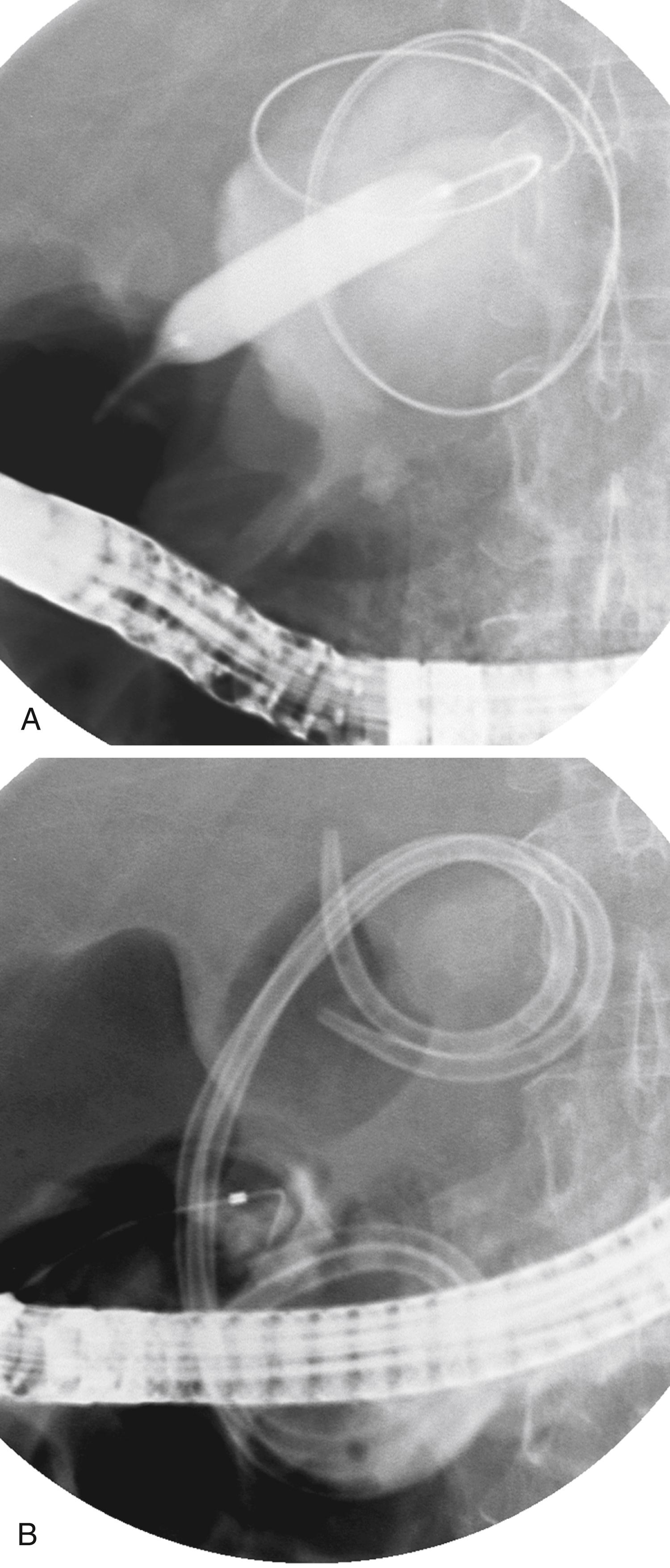 Fig. 61.3, Endoscopic transduodenal drainage of a pancreatic pseudocyst. A, The pseudocyst was entered and a guidewire coiled into the cyst. A dilating balloon has been inflated across the duodenal wall. B, Two double pigtail stents have been placed into the cyst.