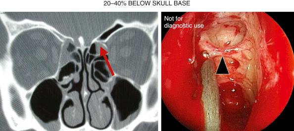 Fig. 4.1, Coronal computed tomographic scan (left) and endoscopic image (right) with the left anterior ethmoid artery indicated (left, arrow; right, arrowhead).