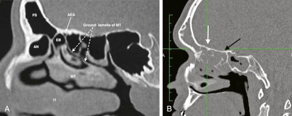 Fig. 4.2, (A) Parasagittal computed tomographic (CT) scan showing the location of the anterior ethmoid artery (AEA), which is usually found between the second and third basal lamellae of the lateral nasal wall. The anterior ethmoid foramen is seen on the skull base between these two structures. (B) Parasagittal CT scan showing the anterior (white arrow) and posterior (black arrow) ethmoid arteries on the skull base. AN, Agger nasi; EB, ethmoid bulla; FS, frontal sinus; IT, inferior turbinate; MT, middle turbinate.