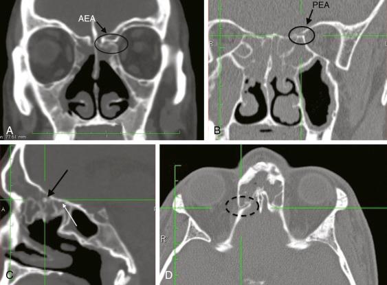 Fig. 4.3, (A) Computed tomographic (CT) scan of a patient with an anterior ethmoid artery (AEA) lying below the skull base. This coronal CT shows the left AEA on a mesentery, leaving the orbit between the medial rectus and superior oblique muscles. (B) Coronal CT scan showing the posterior ethmoid artery (PEA) on the skull base at the level of the posterior ethmoids. (C) Parasagittal CT showing the AEA lying well below the skull base in the ethmoid sinus (black arrow). The PEA is not as clearly seen (white arrow), but it is lying in its usual position at the junction of the posterior ethmoids and front face of the sphenoid. (D) Axial CT showing the AEA as it exits the orbit.