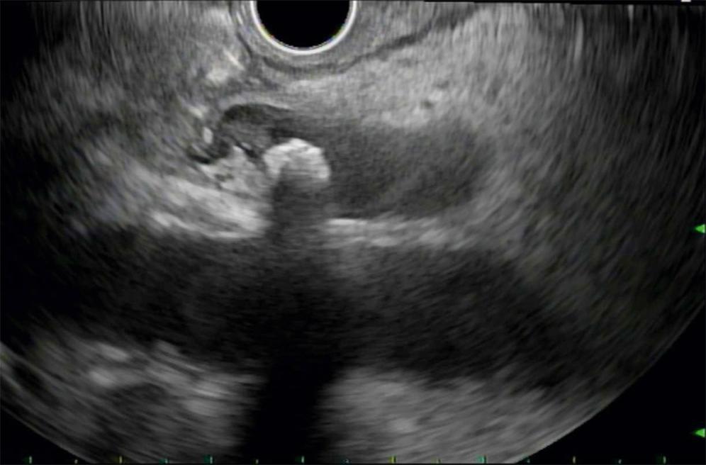 Fig. 70.2, EUS image demonstrating choledocholithiasis. Note a single stone in the middle third of the bile duct. Stones have a hyperechoic interface with the EUS transducer and postacoustic shadowing.