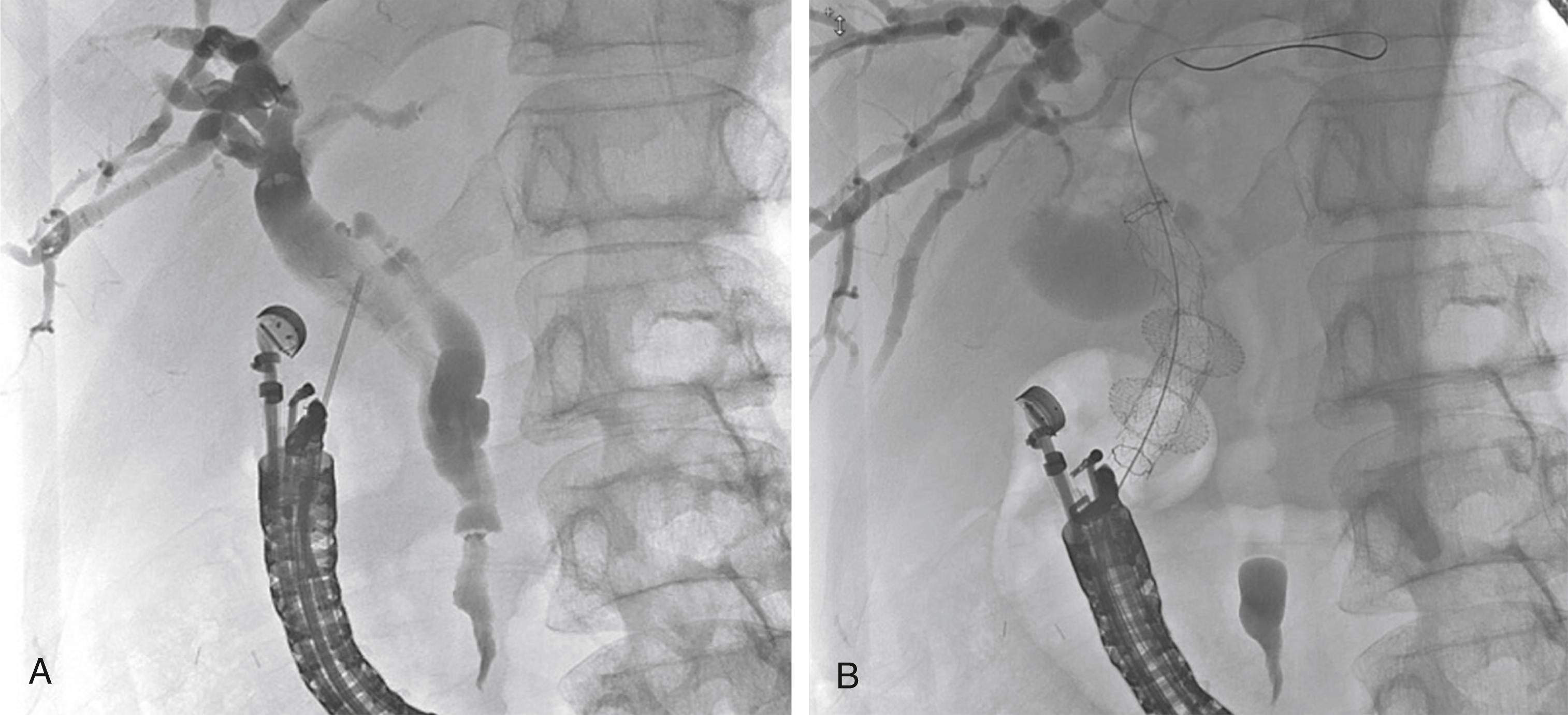 Fig. 70.3, Fluoroscopic images of EUS-guided choledochoduodenostomy (CD) in a patient with malignant biliary obstruction due to metastatic melanoma. A , Radiographic image showing contrast material injection into the biliary tract through a 19-gauge needle. A stricture is seen in the distal bile duct. B , Radiographic image showing lumen-apposing metal CD stent in place. A 10-mm by 6-cm fully covered metal stent was placed through the CD stent into the bile duct, and a 7-Fr plastic stent was placed within the fully covered metal stent.