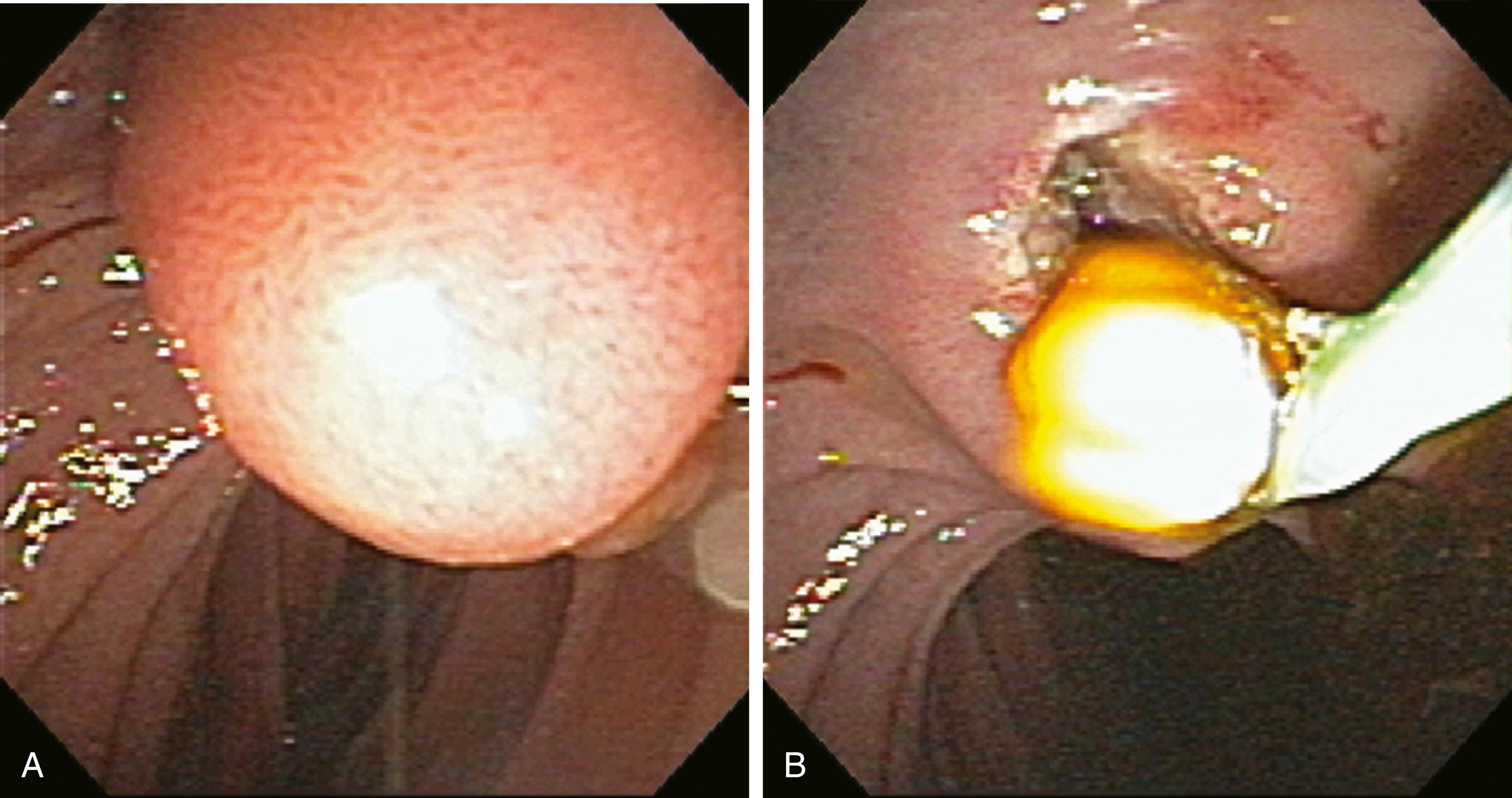 Fig. 70.5, Endoscopic images during removal of a bile duct stone. A, A bulging papilla consistent with an impacted stone is seen. B, After endoscopic sphincterotomy, the stone is extracted.