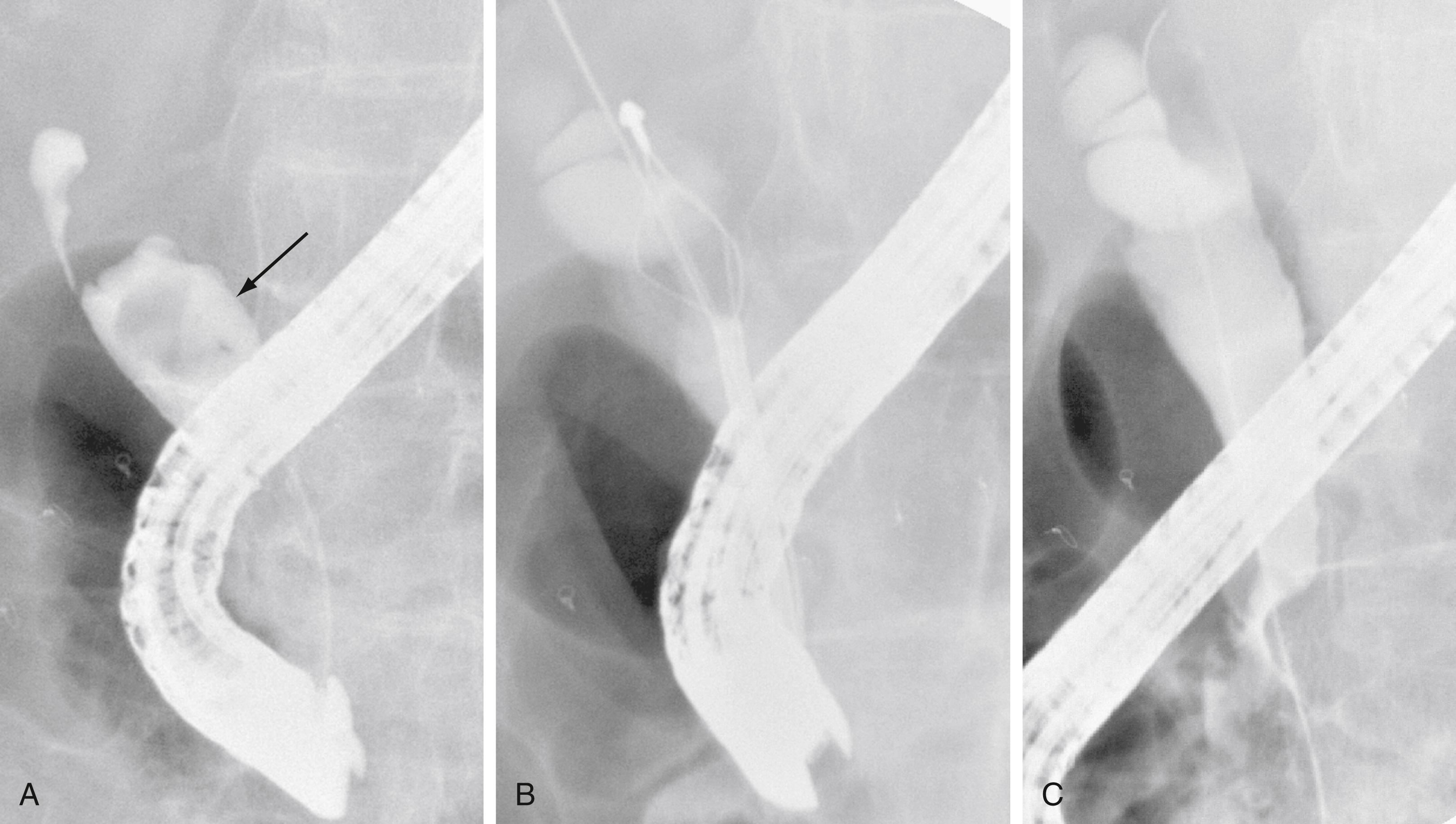 Fig. 70.6, Mechanical lithotripsy of a bile duct stone. A, Endoscopic retrograde cholangiogram showing a large stone ( arrow ). B, Lithotripsy basket crushing the stone. C, Follow-up cholangiogram shows clearance of the stone from the bile duct.