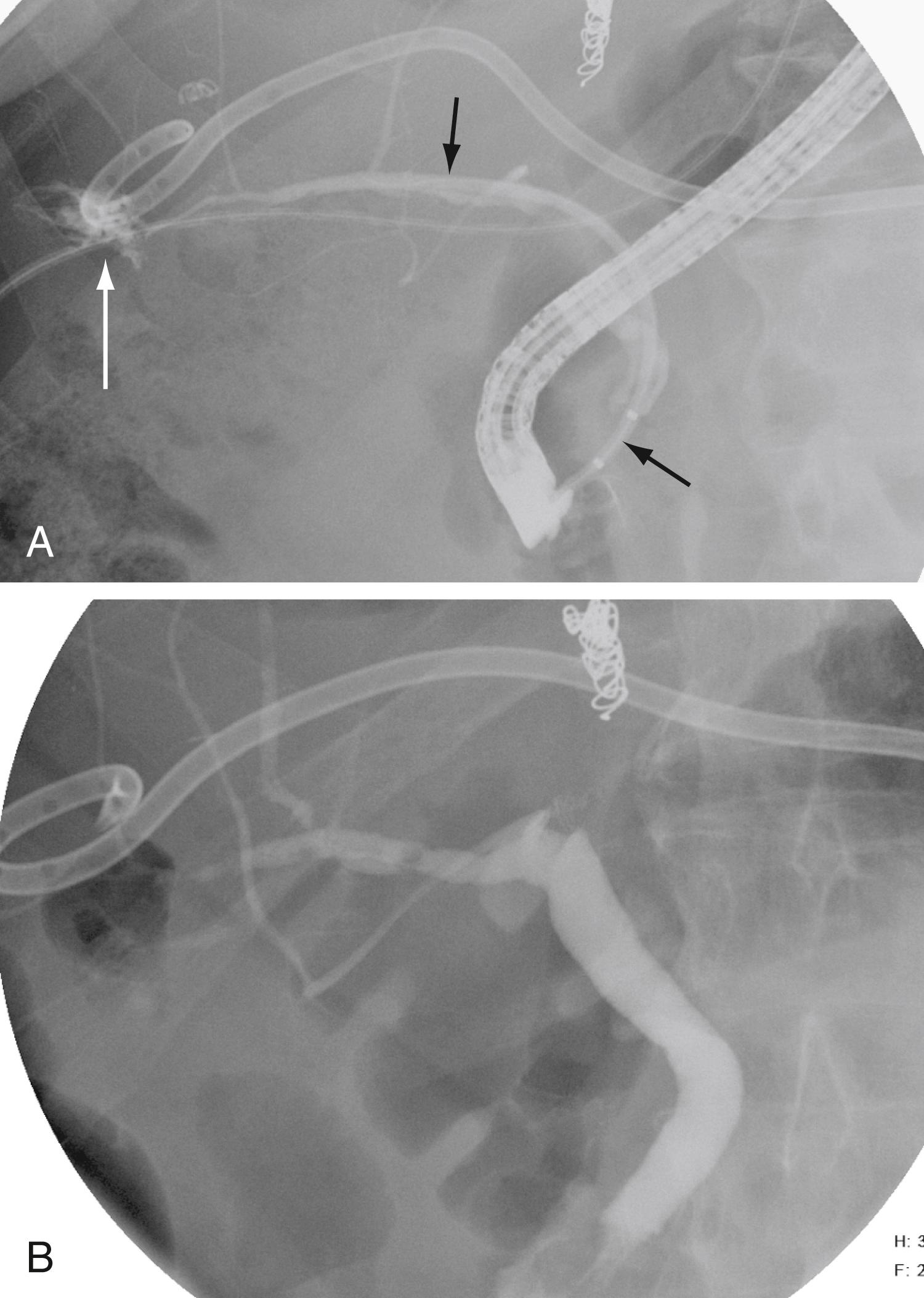 Fig. 70.7, Intrahepatic bile leak after a hepatectomy treated endoscopically. A, Contrast extravasation ( long arrow ) is seen near the percutaneous drain; an internal biliary stent ( short arrows ) is placed. B, Follow-up cholangiogram shows resolution of the leak.