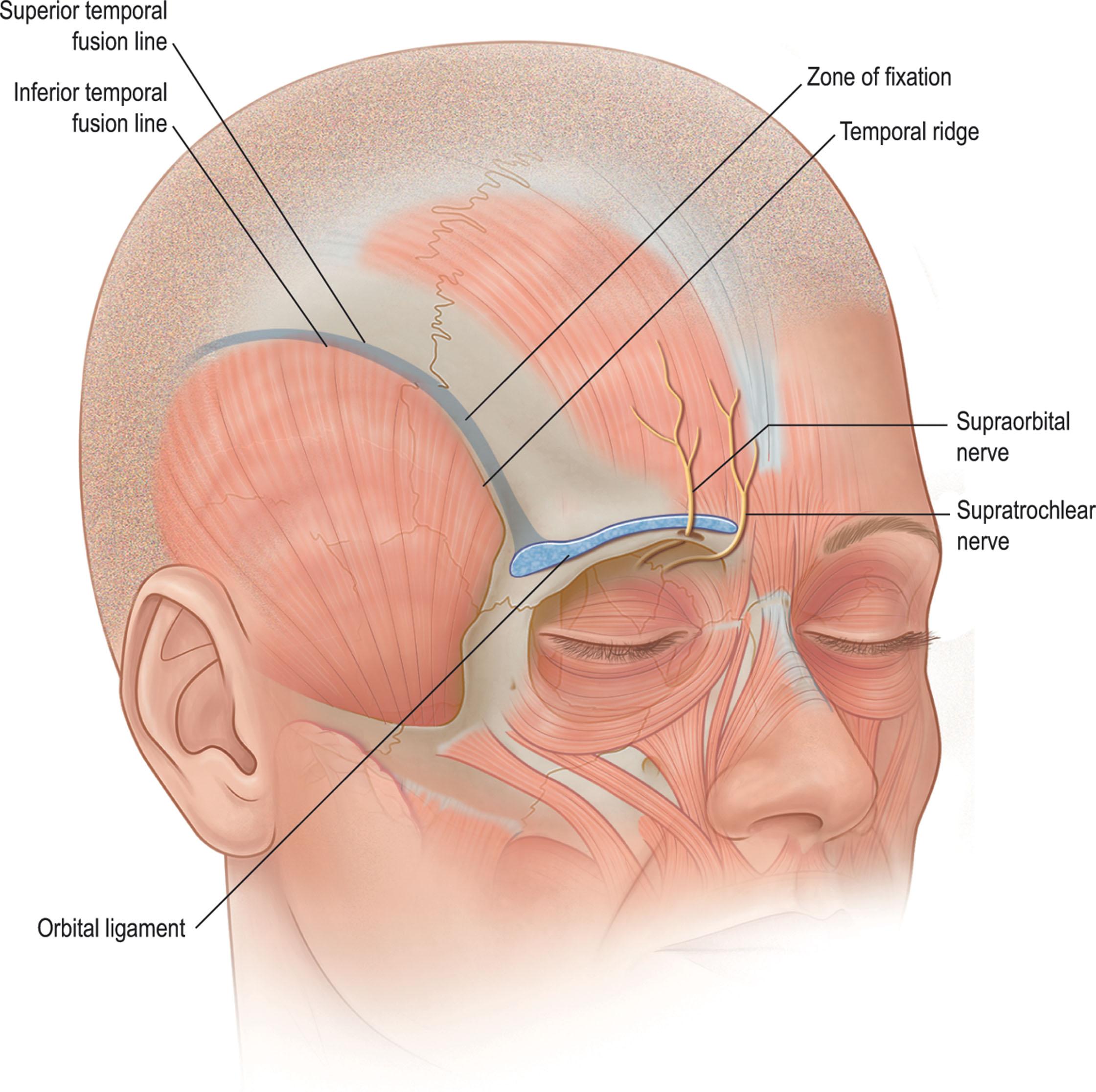 Figure 12.1, Structural landmarks in the brow. The temporal fusion line lies at the junction of the periosteum and the deep temporal fascia. It must be released to achieve brow mobility. The orbital retaining ligament, situated at the lateral supraorbital rim, must also be released.