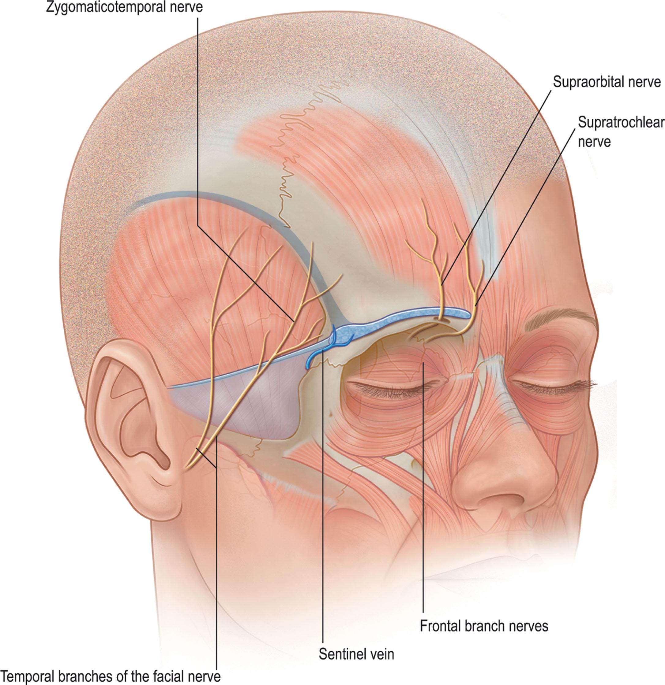 Figure 12.2, Sensory and motor nerve supply to the brow. The supraorbital and supratrochlear nerves are protected during dissection. The frontal branches of the facial nerve lie anterior to the deep temporal fascia.