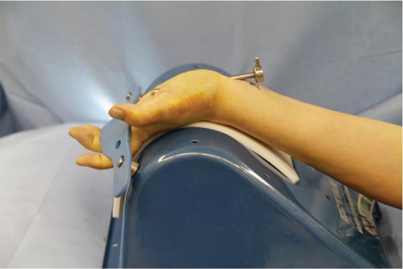 FIGURE 56.1, Wrist is extended for cannula placement.