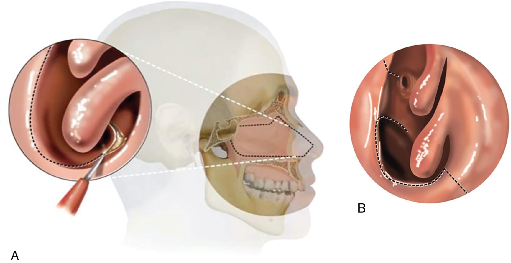 Fig. 33.1, Demonstration of a nasoseptal flap. A and B, The incision along the septum and inferior floor of the nasal cavity helps define the nasoseptal flap pedicled off the sphenopalatine artery.