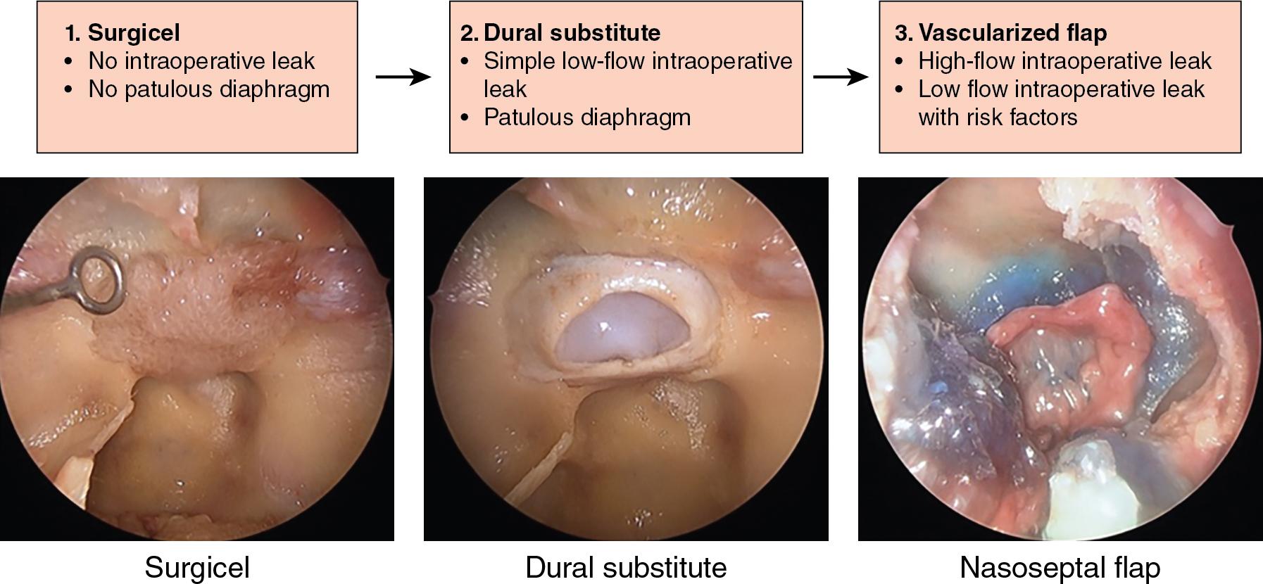 Fig. 33.2, Reconstructive algorithm for various levels of cerebrospinal fluid (CSF) leak during routine transsphenoidal surgery. A tiered level of repair from level 1 to 3 is shown for various CSF leak scenarios.