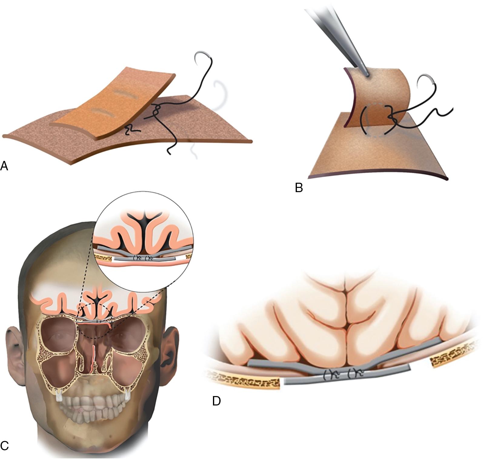 Fig. 33.3, Demonstration of a button graft repair. A and B, A bilayered sutured fascia lata button is created with the inner layer approximately 30% larger than the outer layer. C and D, The button is placed around a dural defect with the leaflets design to hold the graft in position.