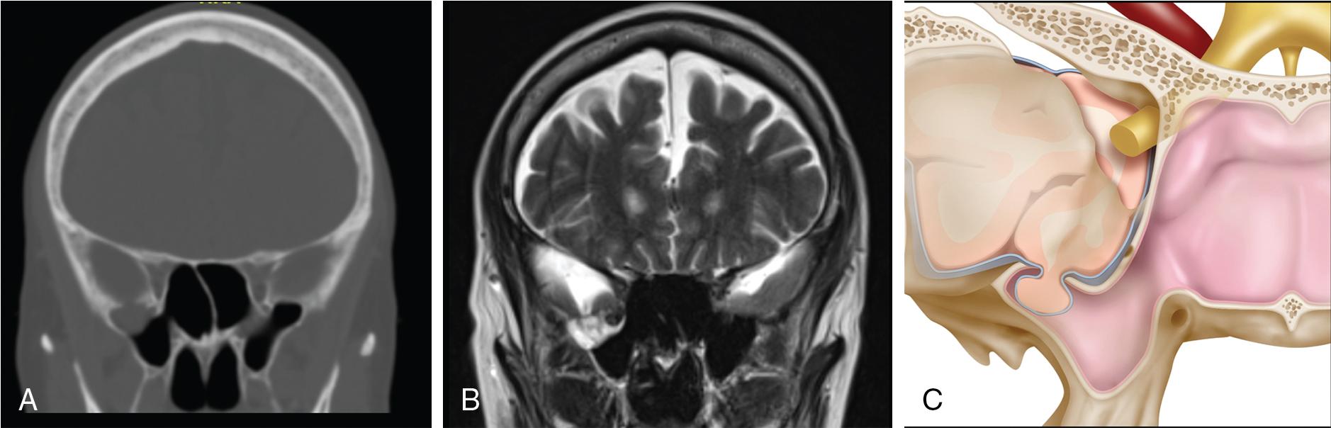 Fig. 34.1, A, Coronal computed tomography through the sphenoid demonstrating a defect in the inferolateral aspect of the middle cranial fossa with an associated meningoencephalocele into the aerated pterygoid recess of the right sphenoid sinus. B, T2-weighted magnetic resonance imaging with meningoencephalocele herniating through the defect into the right lateral sphenoid sinus. C, Illustration demonstrating a defect in the inferolateral aspect of the middle cranial fossa with an associated meningoencephalocele into the aerated pterygoid recess of the sphenoid sinus.