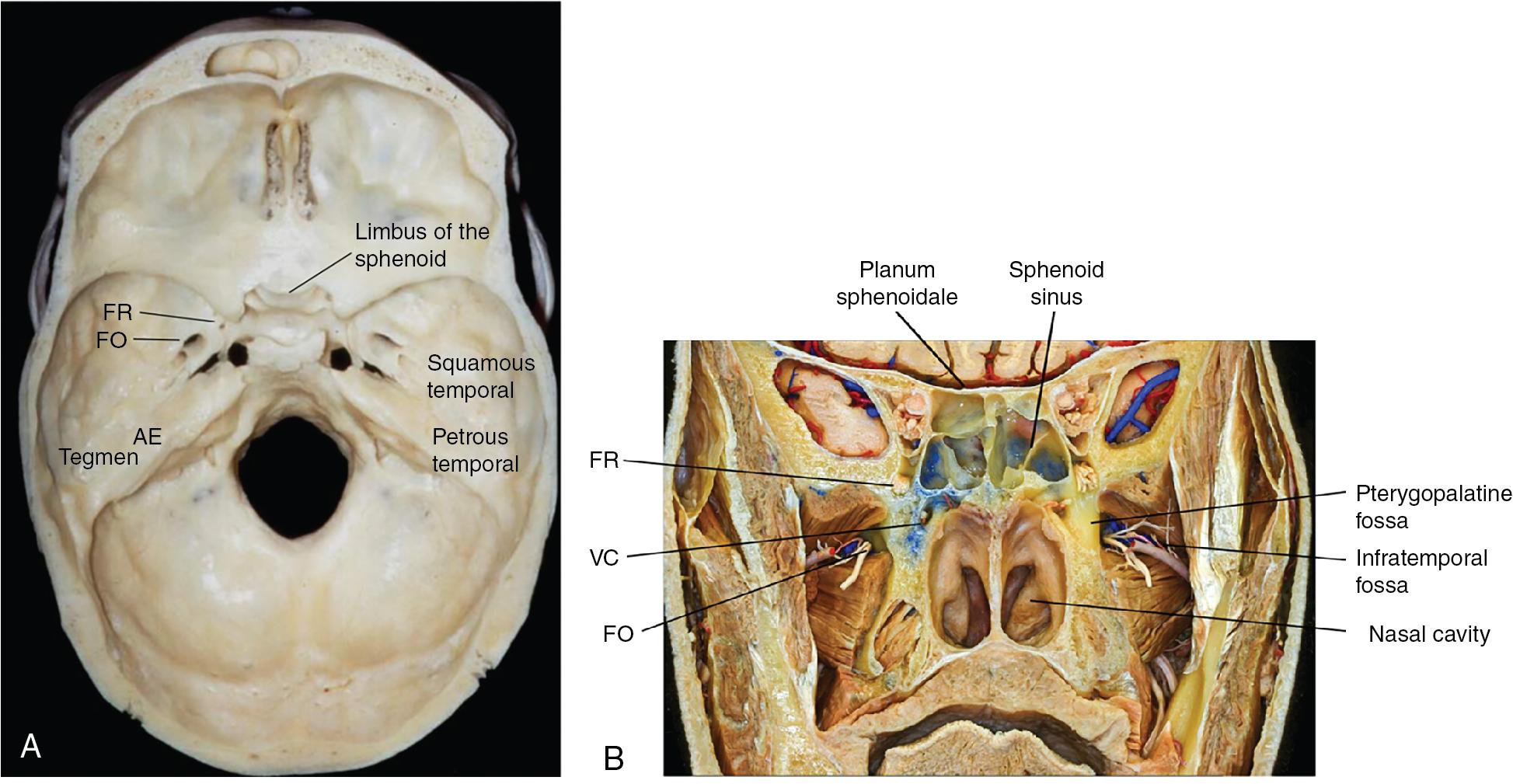 Fig. 34.2, A, Axial view of the middle fossa boundaries and contents. B, Coronal view of the middle fossa. AE, Arcuate eminence; FR, foramen rotundum; FO, foramen ovale; VC, vidian canal.