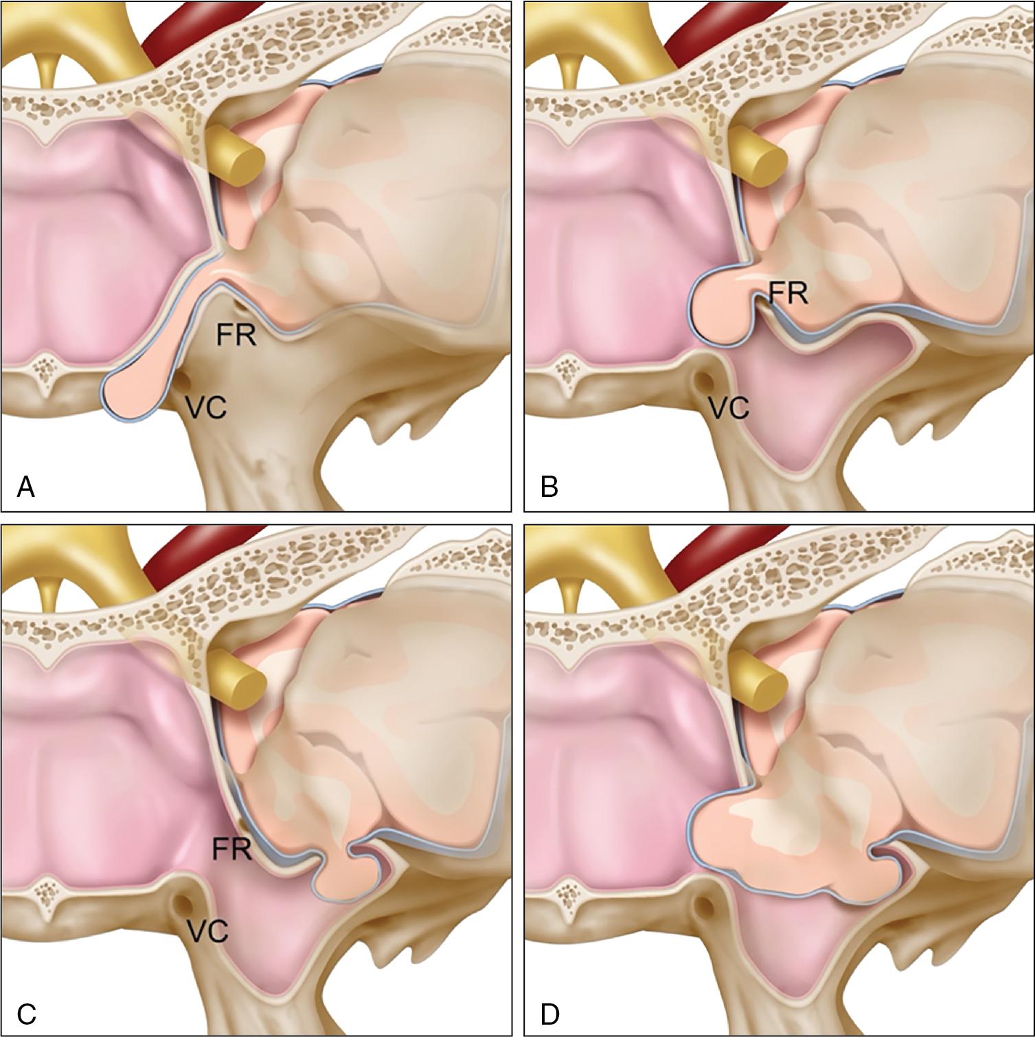 Fig. 34.3, Artist depiction of the four types of lateral sphenoid meningoencephaloceles. A, Type 1 Sternberg canal sphenoid encephalocele located superomedial to the foramen rotundum (FR) and medial to the vidian canal (VC). B, Type 2 sphenoid encephalocele superomedial to the FR with an associated encephalocele into the hyperaerated sphenoid sinus. C, Type 3 sphenoid encephalocele inferolateral to the FR into the aerated pterygoid recess of the sphenoid sinus. D, Type 4 large osseous defect in the middle cranial fossa at the location of the FR with an associated encephalocele into an aerated pterygoid recess.