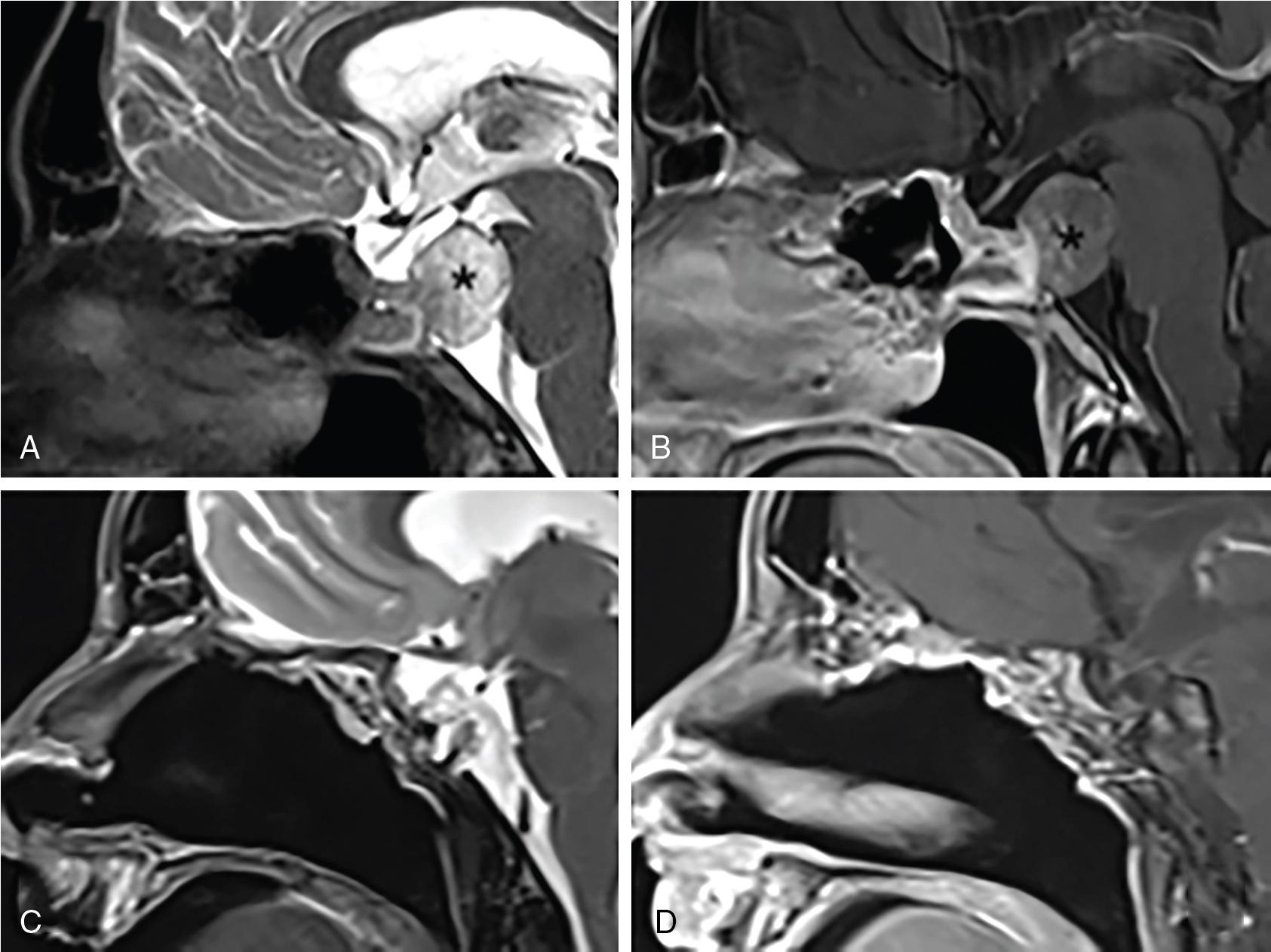 Fig. 35.1, Preoperative T2-weighted ( A ) and contrast-enhanced T1-weighted ( B ) and postoperative T2-weighted ( C ) and contrast-enhanced T1-weighted ( D ) magnetic resonance imaging of a clival chordoma in a 66-year-old man treated by an endoscopic transclival approach with total resection of the neoformation and a multilayer skull base reconstruction with bilateral Hadad flap.