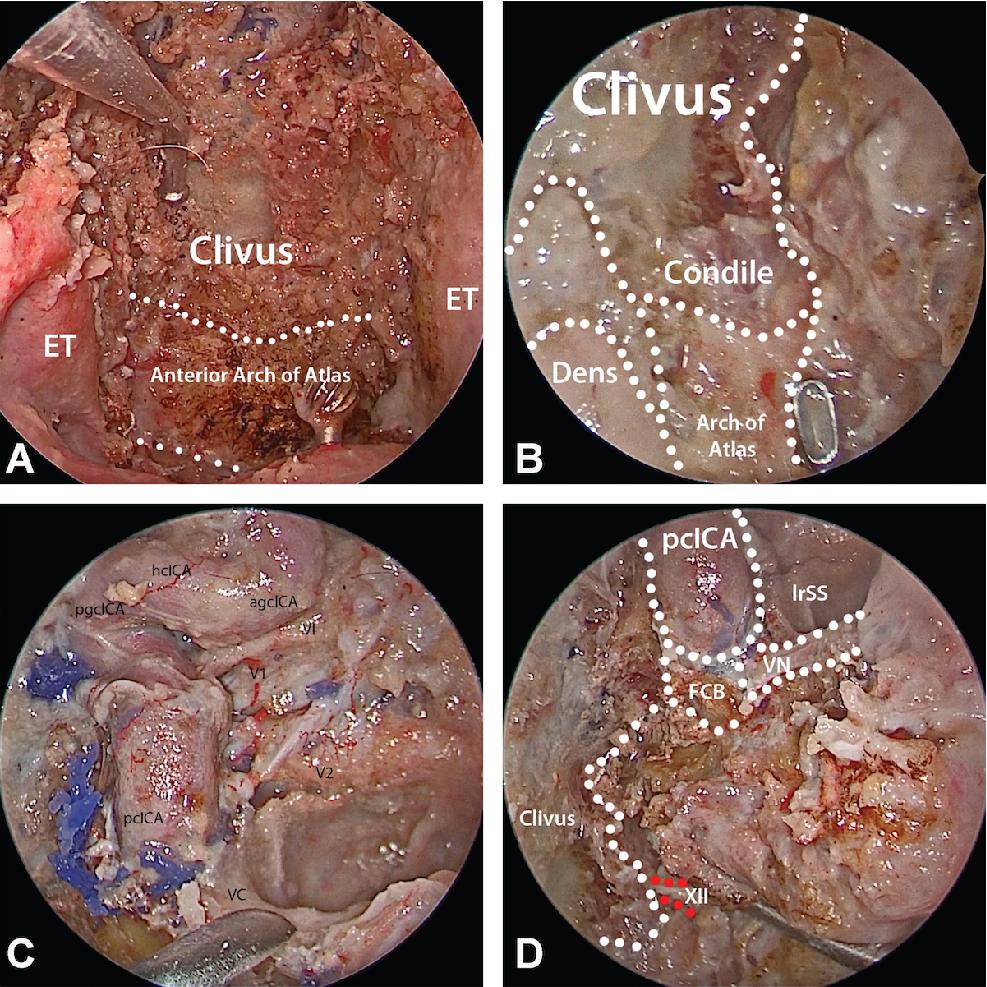 Fig. 35.2, Transclival approach, anatomic dissection. A, Exposure of the clivus. B, Approach to the condyle. C, Relationship between the carotid artery and clivus. D, Identification of the hypoglossal canal. agcICA, Anterior genu cavernous internal carotid artery; ET, eustachian tube; FCB, fibrocartilago basalis; hcICA, horizontal cavernous internal carotid artery; lrSS, l ateral recess sphenoid sinus; pcICA, paraclival internal carotid artery; pgcICA, posterior genu cavernous internal carotid artery; VC, vidian canal; VI, abducens nerve; V1, ophthalmic branch of the trigeminal nerve; V2, maxillary branch of the trigeminal nerve; XII, hypoglossal nerve.