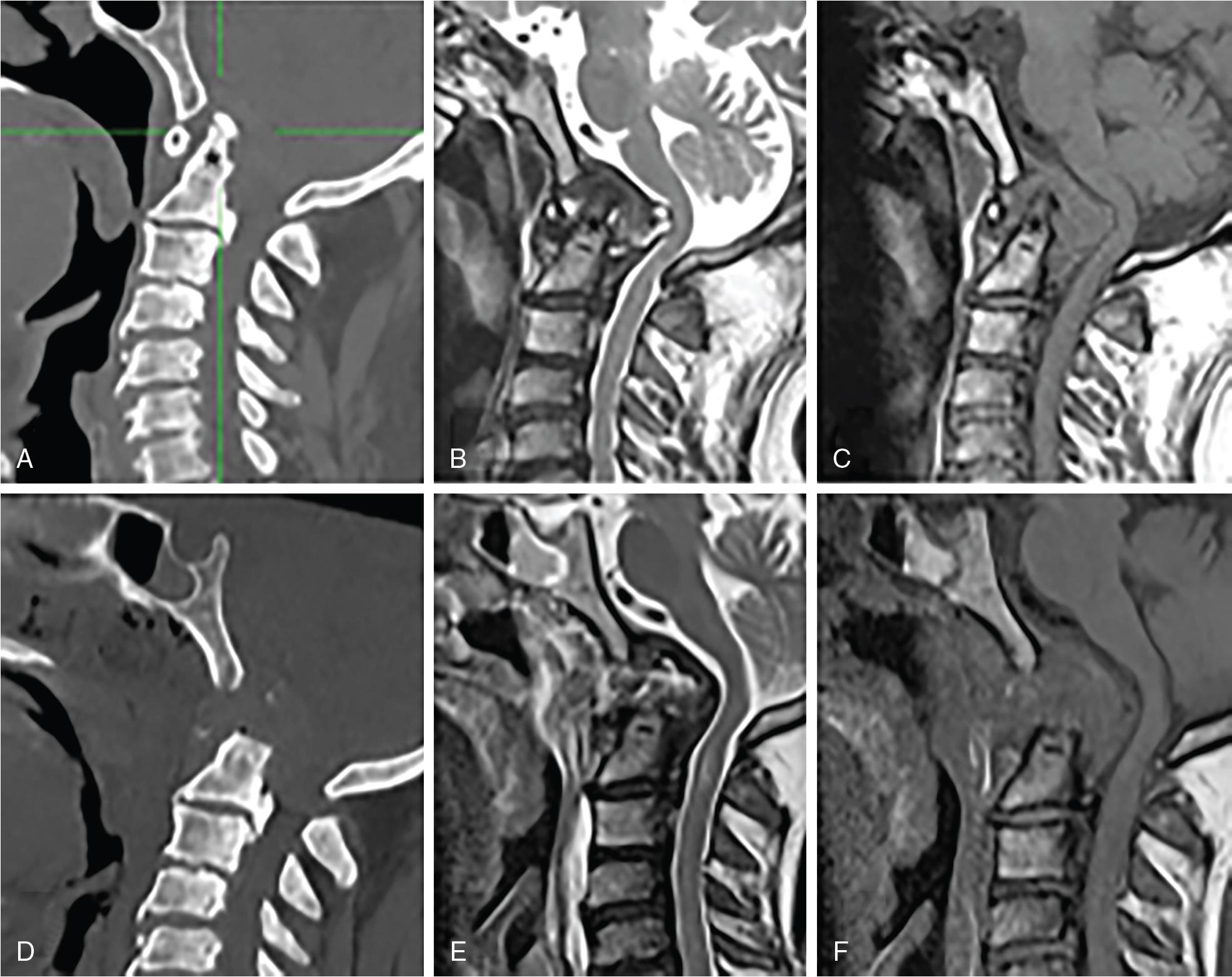 Fig. 35.3, Preoperative computed tomography (CT) scan ( A ), T2-weighted ( B) and contrast-enhanced T1-weighted ( C ) and postoperative CT scans ( E ), T2-weighted ( F ) and contrast-enhanced T1-weighted ( G ) magnetic resonance imaging of a craniovertebral junction malformation in a 74-year-old man with progressive cervical pain treated by an endoscopic transodontoid approach and a multilayer skull base reconstruction with an inferiorly based retropharyngeal mucosal flap.