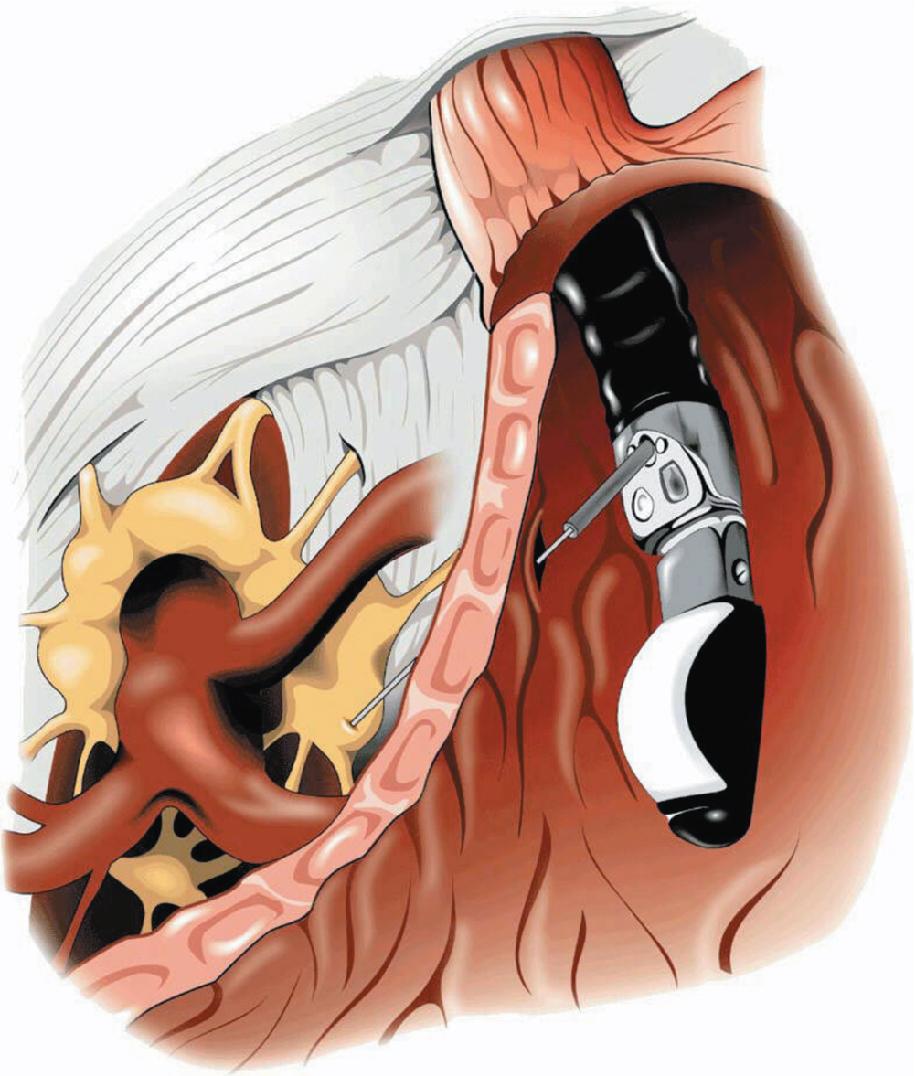 • Fig. 24.1, Illustration of an endoscopic ultrasonography-guided celiac ganglia injection.