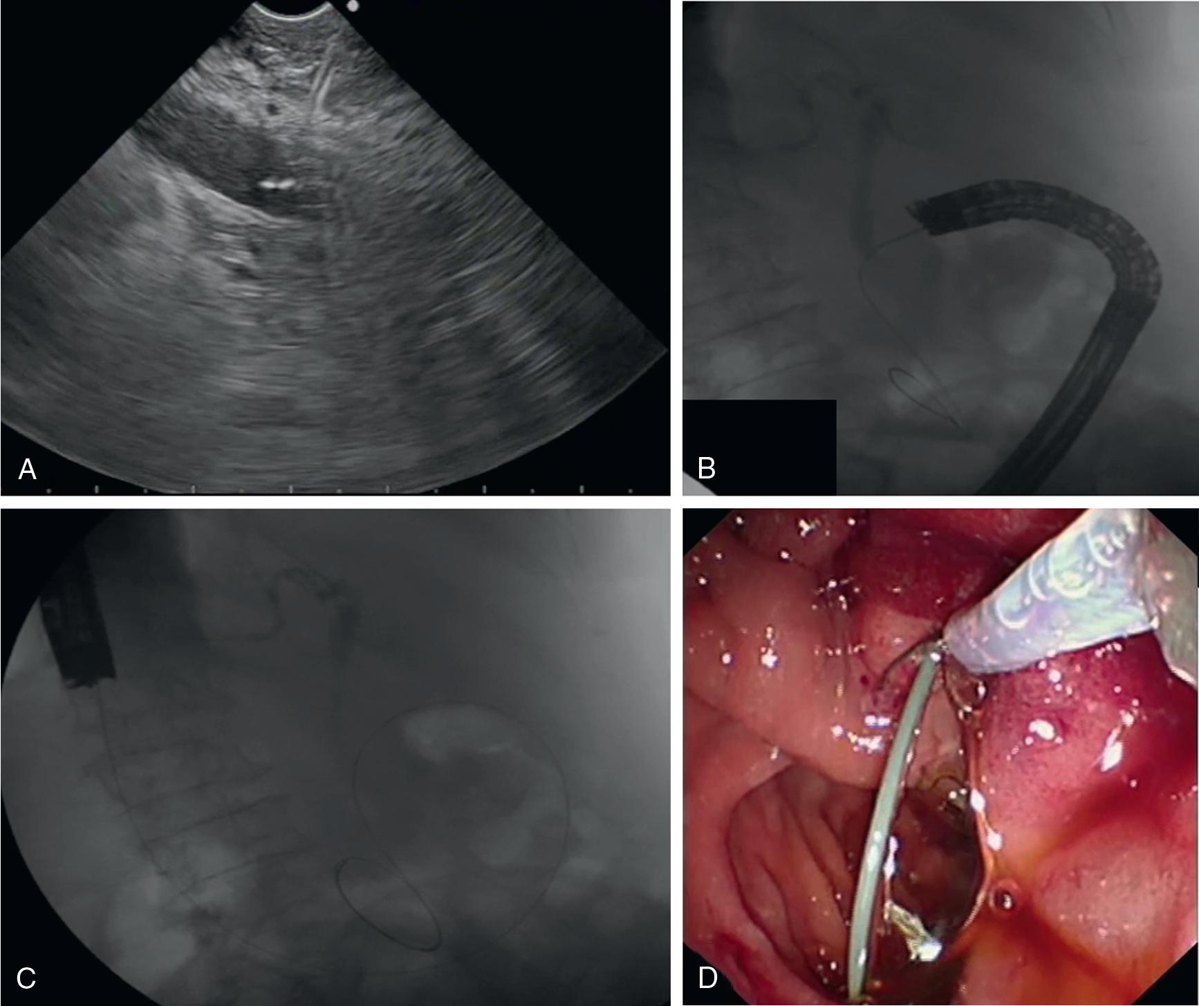 • Fig. 22.4, The endoscopic ultrasonography-guided rendezvous biliary procedure. (A) The common bile duct was punctured with a forward viewing echoendoscope at the first part of the duodenum. (B) The guidewire was passed into the bile duct, through the papilla, and looped in the duodenum. (C) The echoendoscope is changed for a duodenoscope. (D) The wire is retrieved with a snare with the duodenoscope.