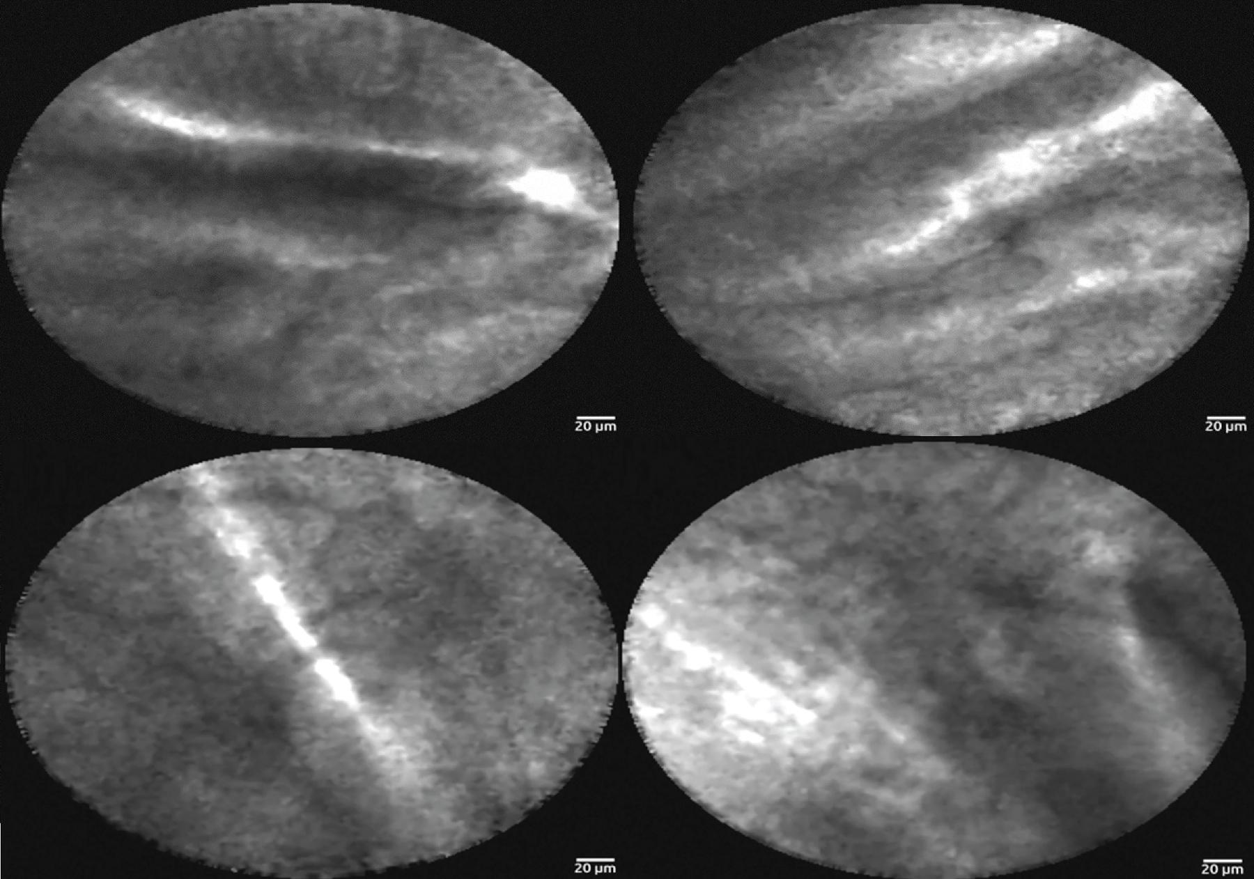 • Fig. 14.5, Confocal laser endomicroscopy (CLE). The four images demonstrate the classical papillary projections associated with intraductal papillary mucinous neoplasia as seen on CLE.