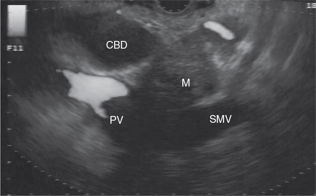 FIGURE 22.2, Solid, irregular, hypoechoic mass (M) in the pancreatic head seen with abrupt termination of a dilated common bile duct (CBD) and contact with the portal confluence (portal vein [PV] and superior mesenteric vein [SMV] ). Cytology obtained by endoscopic ultrasound–guided fine-needle aspiration proved to be adenocarcinoma.