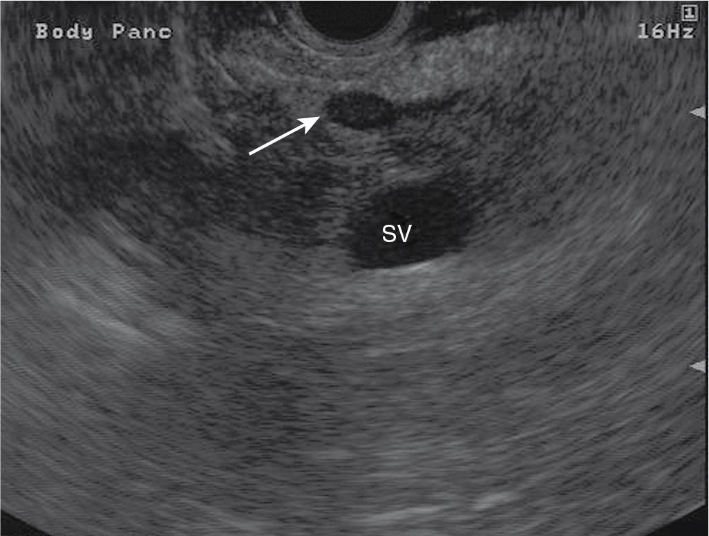 FIGURE 22.3, Small, well-circumscribed, hypoechoic appearance of an insulinoma (arrow) in the body of the pancreas with splenic vein (SV) below.