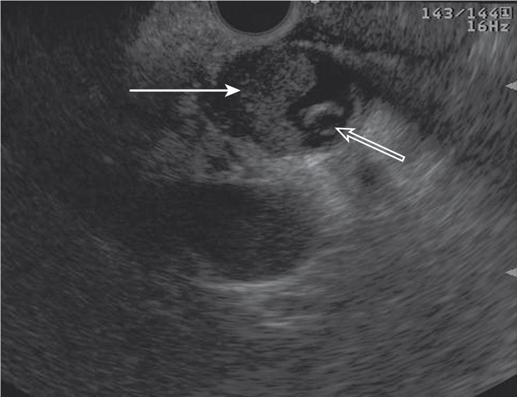 FIGURE 22.5, Hypoechoic mass appearance of cholangiocarcinoma of the common bile duct (solid arrow) with biliary stent visible (open arrow).